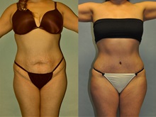 Buttock Lift with Augmentation After Photo by Robert Lowen, MD; Mountain View, CA - Case 50173