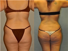 Buttock Lift with Augmentation Before Photo by Robert Lowen, MD; Mountain View, CA - Case 50173