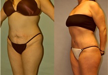 Buttock Lift with Augmentation After Photo by Robert Lowen, MD; Mountain View, CA - Case 50173