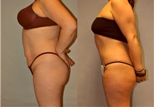 Buttock Lift with Augmentation Before Photo by Robert Lowen, MD; Mountain View, CA - Case 50173