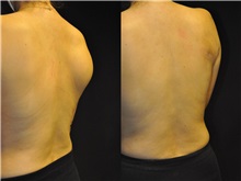 General Reconstruction After Photo by Robert Lowen, MD; Mountain View, CA - Case 50178