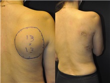 General Reconstruction Before Photo by Robert Lowen, MD; Mountain View, CA - Case 50178