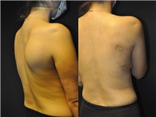 General Reconstruction After Photo by Robert Lowen, MD; Mountain View, CA - Case 50178