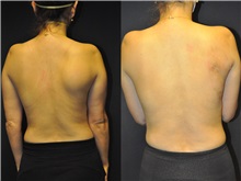 General Reconstruction Before Photo by Robert Lowen, MD; Mountain View, CA - Case 50178