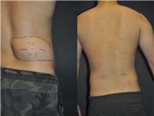 General Reconstruction After Photo by Robert Lowen, MD; Mountain View, CA - Case 50176