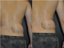 General Reconstruction Before Photo by Robert Lowen, MD; Mountain View, CA - Case 50176