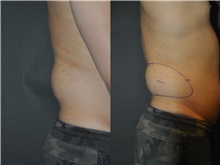 General Reconstruction Before Photo by Robert Lowen, MD; Mountain View, CA - Case 50176