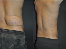 General Reconstruction After Photo by Robert Lowen, MD; Mountain View, CA - Case 50176