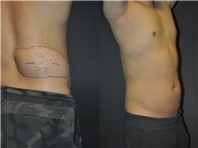 General Reconstruction Before Photo by Robert Lowen, MD; Mountain View, CA - Case 50176