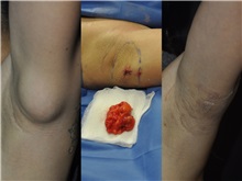 General Reconstruction After Photo by Robert Lowen, MD; Mountain View, CA - Case 50177