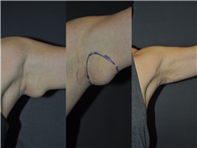 General Reconstruction Before Photo by Robert Lowen, MD; Mountain View, CA - Case 50177