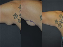 General Reconstruction After Photo by Robert Lowen, MD; Mountain View, CA - Case 50177