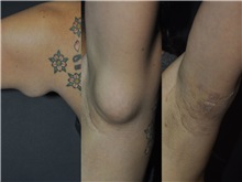 General Reconstruction Before Photo by Robert Lowen, MD; Mountain View, CA - Case 50177