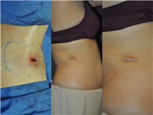 General Reconstruction After Photo by Robert Lowen, MD; Mountain View, CA - Case 50179