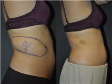 General Reconstruction Before Photo by Robert Lowen, MD; Mountain View, CA - Case 50179