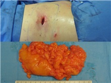 General Reconstruction After Photo by Robert Lowen, MD; Mountain View, CA - Case 50179