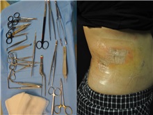 General Reconstruction Before Photo by Robert Lowen, MD; Mountain View, CA - Case 50179