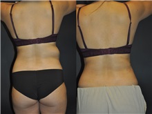 General Reconstruction After Photo by Robert Lowen, MD; Mountain View, CA - Case 50179