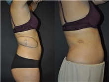 General Reconstruction Before Photo by Robert Lowen, MD; Mountain View, CA - Case 50179