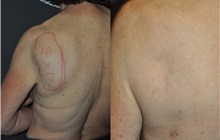 General Reconstruction After Photo by Robert Lowen, MD; Mountain View, CA - Case 50184