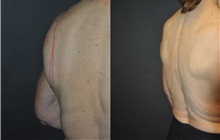 General Reconstruction Before Photo by Robert Lowen, MD; Mountain View, CA - Case 50184