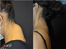 General Reconstruction After Photo by Robert Lowen, MD; Mountain View, CA - Case 50180