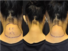 General Reconstruction Before Photo by Robert Lowen, MD; Mountain View, CA - Case 50180