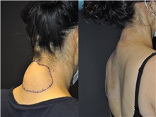 General Reconstruction After Photo by Robert Lowen, MD; Mountain View, CA - Case 50180