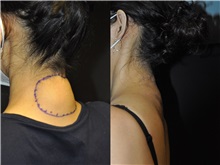 General Reconstruction Before Photo by Robert Lowen, MD; Mountain View, CA - Case 50180