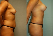 Breast Lift After Photo by Robert Lowen, MD; Mountain View, CA - Case 50188