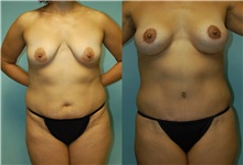 Breast Lift Before Photo by Robert Lowen, MD; Mountain View, CA - Case 50188
