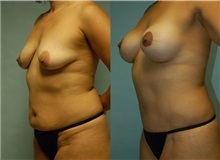 Breast Lift After Photo by Robert Lowen, MD; Mountain View, CA - Case 50188