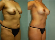 Breast Lift Before Photo by Robert Lowen, MD; Mountain View, CA - Case 50188