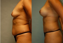 Breast Lift After Photo by Robert Lowen, MD; Mountain View, CA - Case 50188