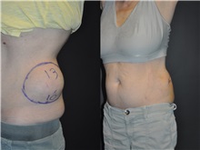 General Reconstruction After Photo by Robert Lowen, MD; Mountain View, CA - Case 50181