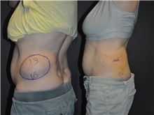 General Reconstruction Before Photo by Robert Lowen, MD; Mountain View, CA - Case 50181