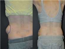 General Reconstruction After Photo by Robert Lowen, MD; Mountain View, CA - Case 50181