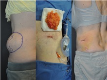 General Reconstruction Before Photo by Robert Lowen, MD; Mountain View, CA - Case 50181