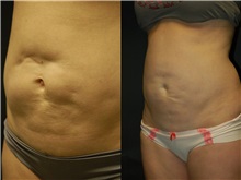 General Reconstruction After Photo by Robert Lowen, MD; Mountain View, CA - Case 50191