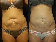 General Reconstruction Before Photo by Robert Lowen, MD; Mountain View, CA - Case 50191