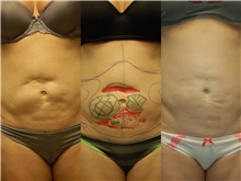 General Reconstruction After Photo by Robert Lowen, MD; Mountain View, CA - Case 50191