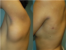 General Reconstruction After Photo by Robert Lowen, MD; Mountain View, CA - Case 50182