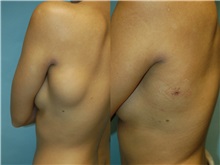 General Reconstruction Before Photo by Robert Lowen, MD; Mountain View, CA - Case 50182