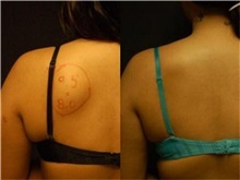 General Reconstruction After Photo by Robert Lowen, MD; Mountain View, CA - Case 50183