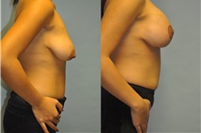 Breast Lift After Photo by Robert Lowen, MD; Mountain View, CA - Case 50189