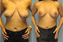 Breast Lift Before Photo by Robert Lowen, MD; Mountain View, CA - Case 50189