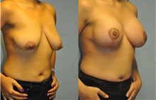 Breast Lift After Photo by Robert Lowen, MD; Mountain View, CA - Case 50189