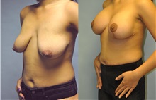 Breast Lift Before Photo by Robert Lowen, MD; Mountain View, CA - Case 50189