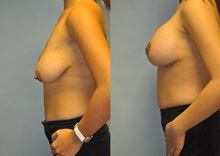 Breast Lift After Photo by Robert Lowen, MD; Mountain View, CA - Case 50189