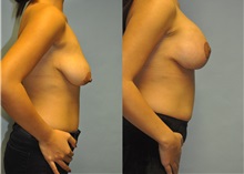 Breast Lift Before Photo by Robert Lowen, MD; Mountain View, CA - Case 50189
